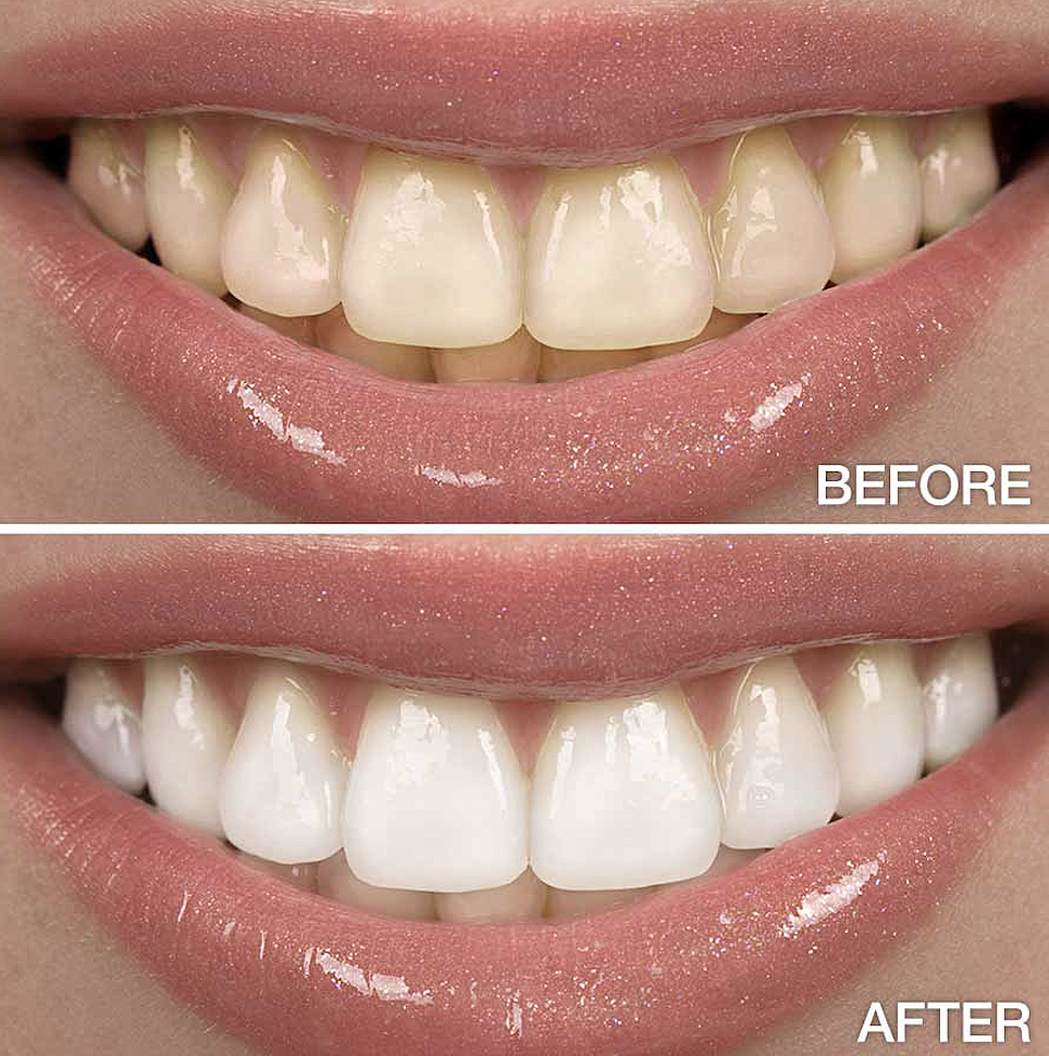 ✨ Next-Gen Dissolving Whitening Strips | Upgraded Formula, Zero Sensitivity 🦷